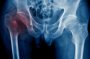 شکستگی مفصل ران